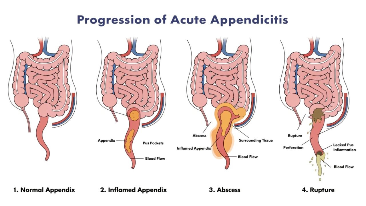 4 stages of appendicitis – Act Fast