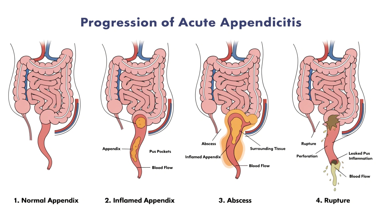 4 stages of appendicitis
